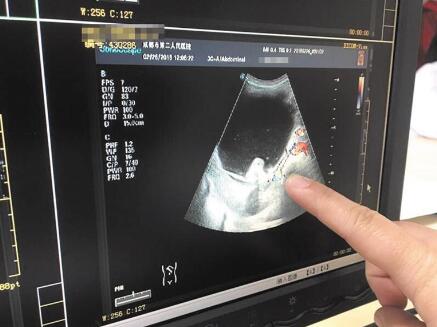 卵巢畸胎瘤会引起肚子痛吗,卵巢畸胎瘤会引起腹部酸胀