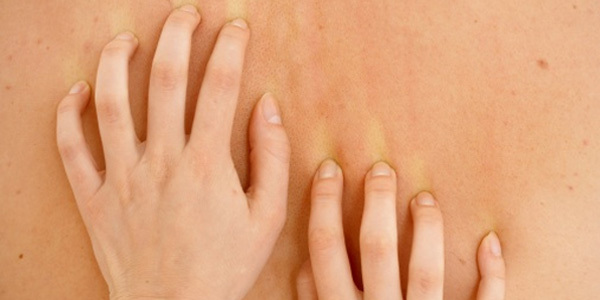 越挠越起红疙瘩如何快速消退,越痒越抓越多的皮炎