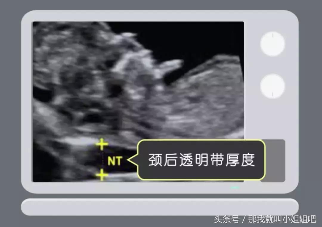 孕妈nt检查要多少费用,孕妈必读四维彩超那些事你懂多少