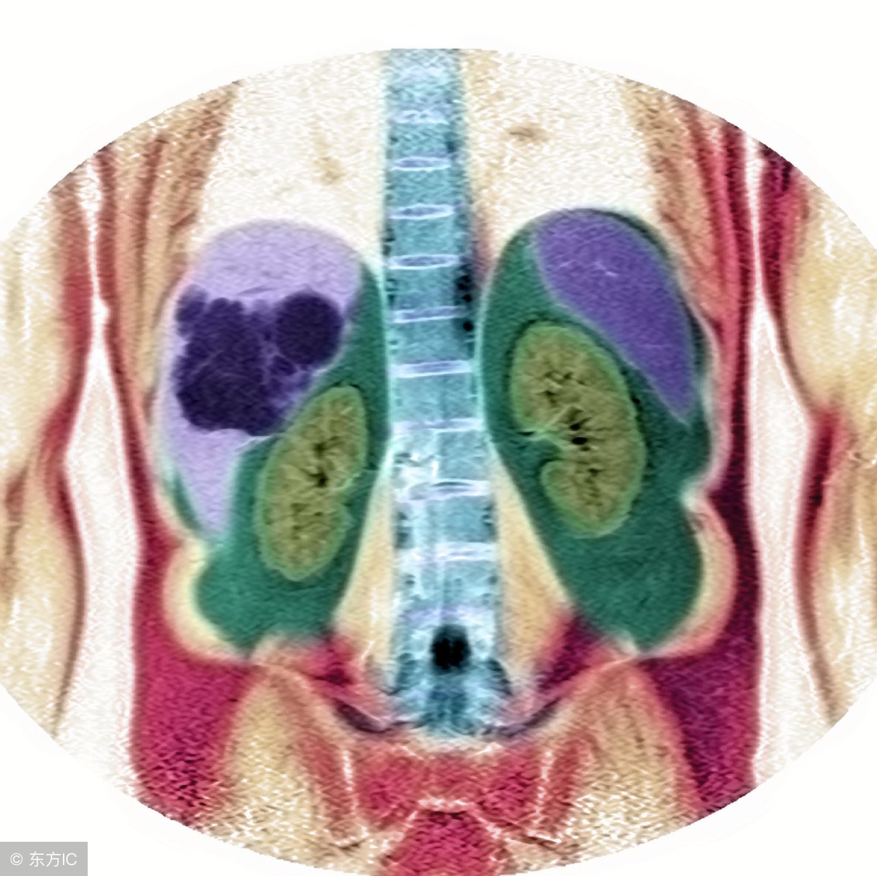 肝血管瘤临床诊疗指南最新版,肝血管瘤10mm没有任何症状