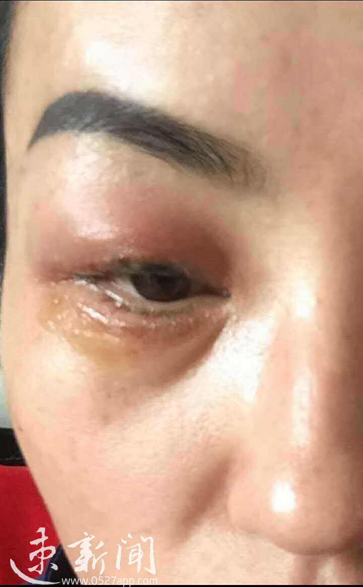 宿迁洗眼线,宿迁一女子美容祛斑毁容