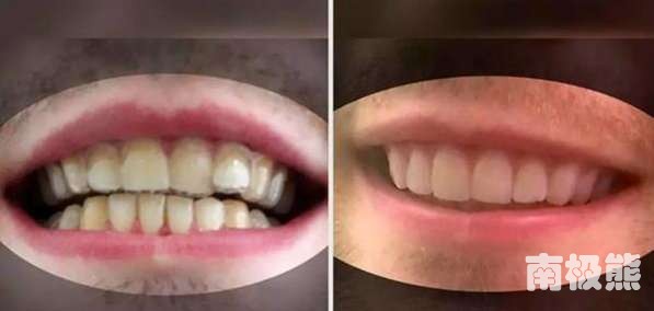 直接3d打印隐形矫正牙套,3d打印隐形牙套制作过程