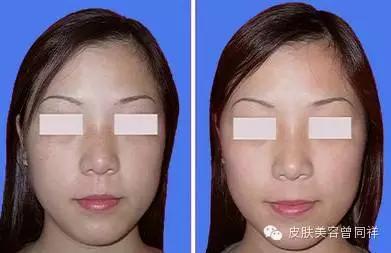 超q激光祛斑 (调q和点阵激光祛斑哪个效果好)