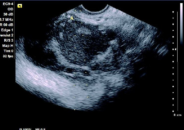 卵巢巧克力囊肿彩超描述,卵巢巧克力囊肿的超声诊断要点