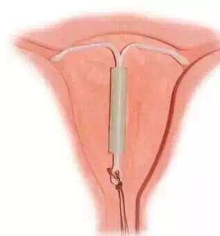 为何女性可以上环男性不可以结扎,上环一年了刺激出血有炎症