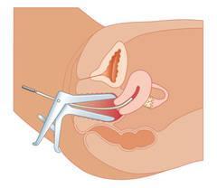 顺产侧切有什么影响？如何恢复已经全部总结验收？