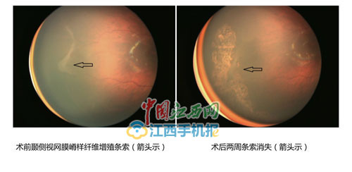 早产儿视网膜病变激光手术时间,激光治疗早产儿视网膜病变后遗症