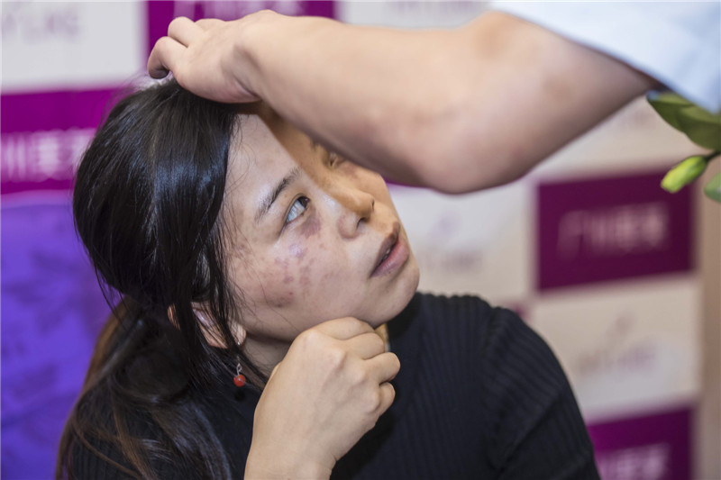 街边化妆店体验雀斑,化妆品店祛雀斑不用店内产品