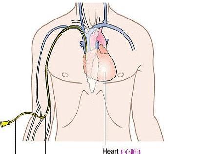 超声引导下改良塞丁格技术解剖图,超声引导下pdca置管