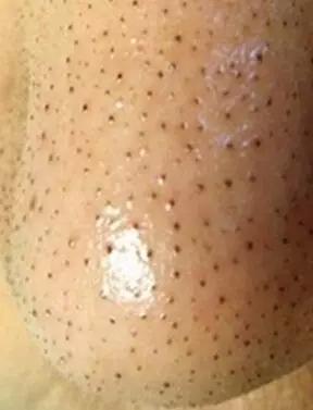 为什么粉刺不挤也有印子,为什么粉刺老是挤不干净