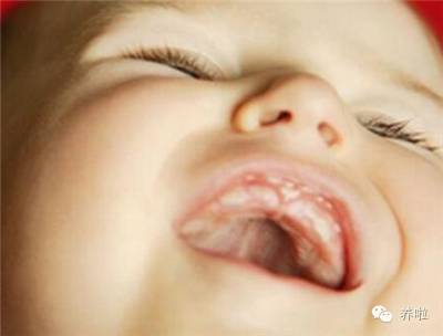 宝宝嘴里起鹅口疮和马牙怎么办,如何区分宝宝口腔马牙和鹅口疮
