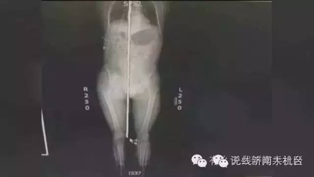 济南男子被1米长钢筋从阴部穿到脑部30名专家开颅开胸开腹手术7小时保住命