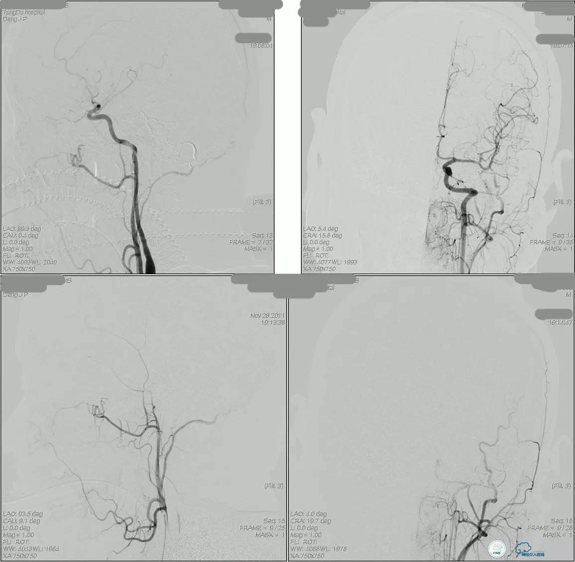 球囊辅助Onyx栓塞治疗硬脑膜动静脉瘘（DAVF）
