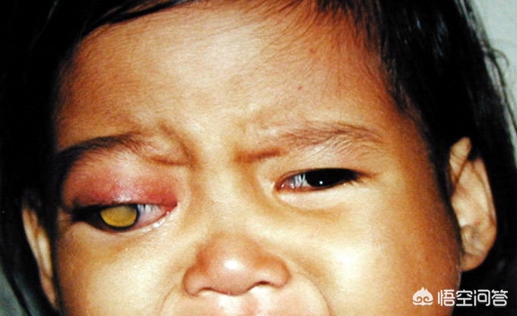 先天性视网膜母细胞瘤可以治疗吗,1岁多宝宝得了视网膜母细胞瘤