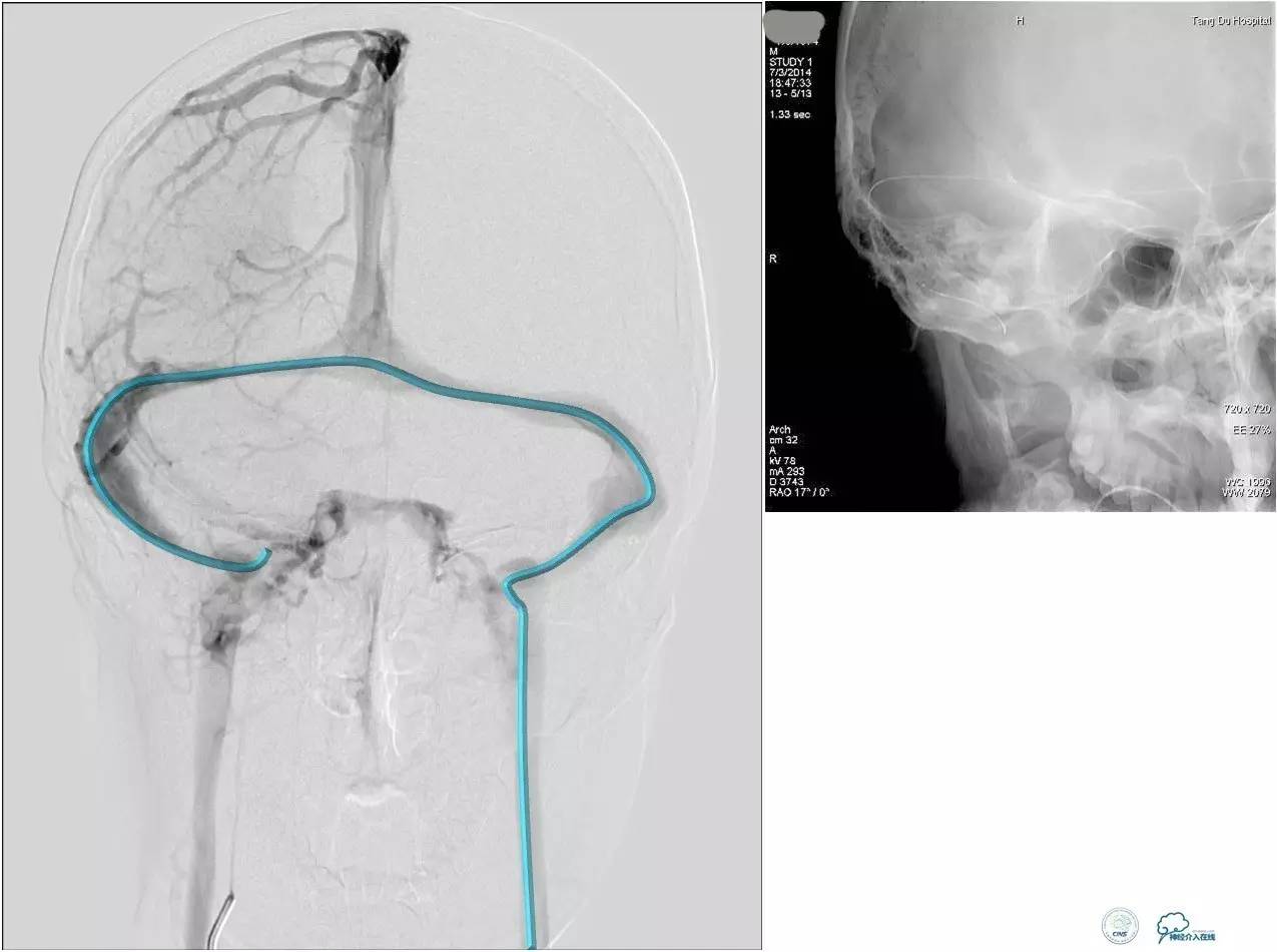 球囊辅助Onyx栓塞治疗硬脑膜动静脉瘘（DAVF）