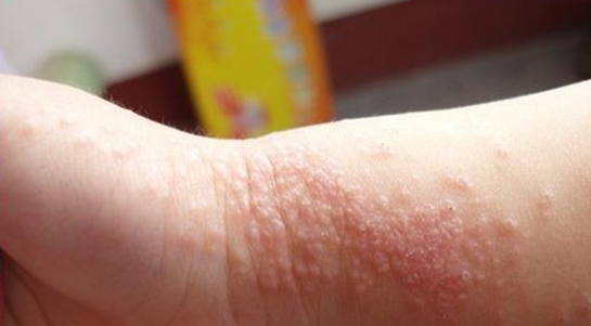 蝼蛄疮的中医治疗,中医对于疮痈的治法