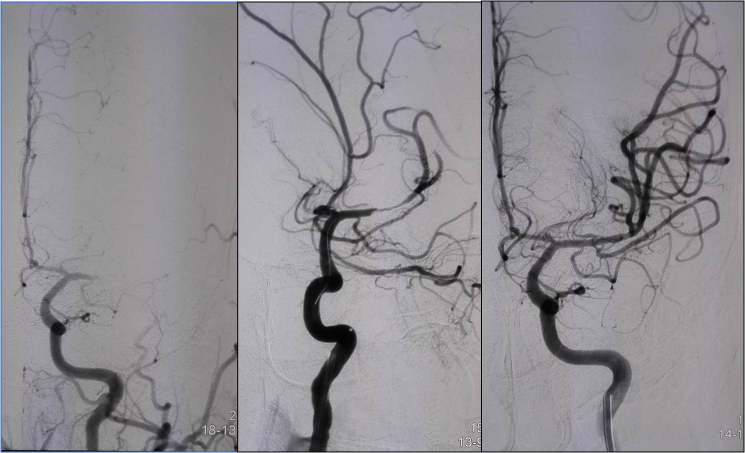 缺血性脑卒中术后管理,急性缺血性脑卒中血管内治疗