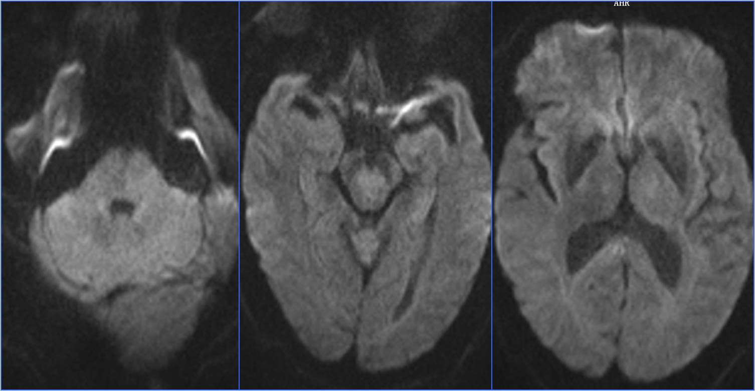 缺血性脑卒中术后管理,急性缺血性脑卒中血管内治疗