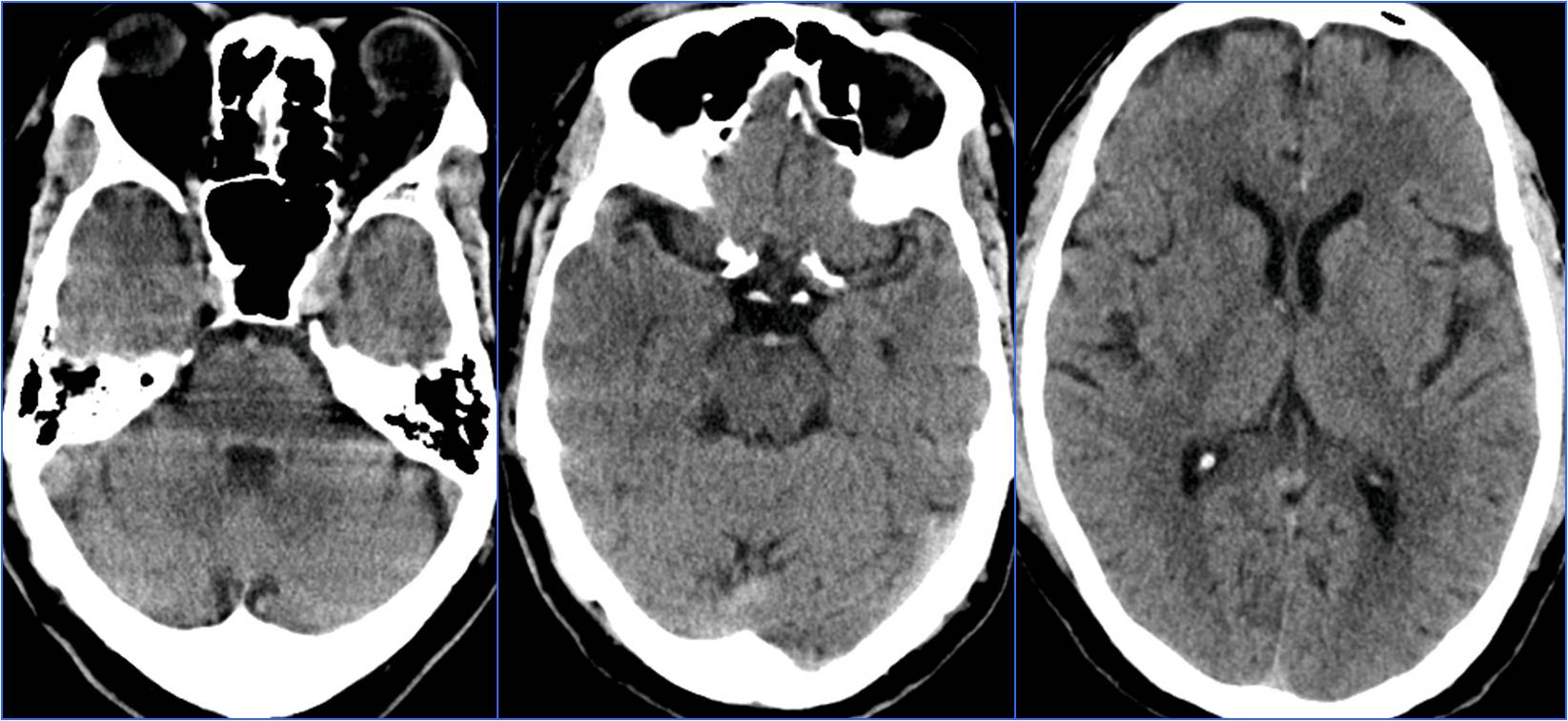 缺血性脑卒中术后管理,急性缺血性脑卒中血管内治疗