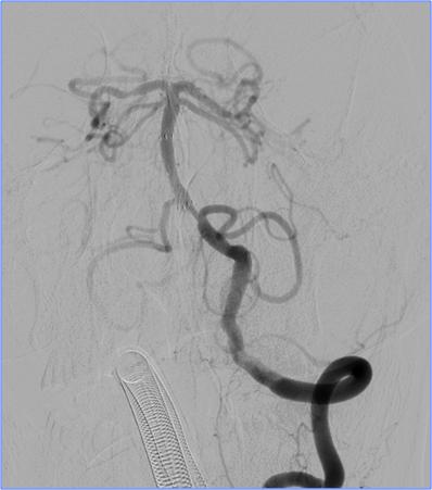 缺血性脑卒中术后管理,急性缺血性脑卒中血管内治疗