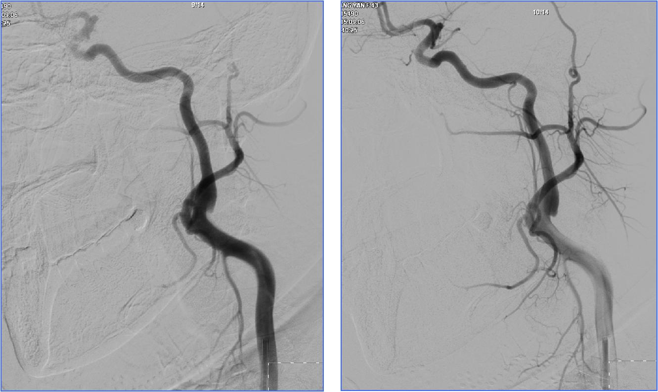 缺血性脑卒中术后管理,急性缺血性脑卒中血管内治疗