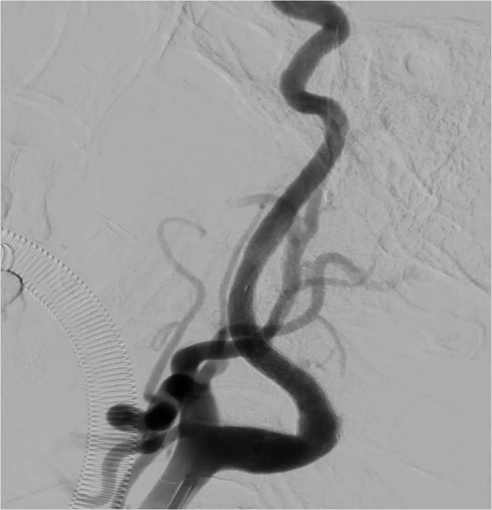 急性缺血性脑卒中血管内治疗,缺血性脑血管病的抗血小板药治疗