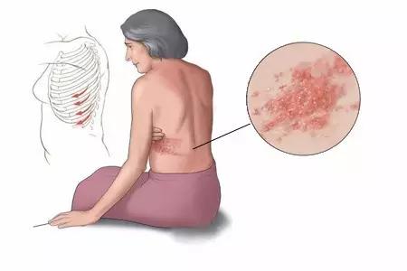 中医带状疱疹的治疗经典名方,带状疱疹中药方剂医案