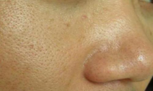 黑头怎么才能去掉,去黑头的误区都有哪些