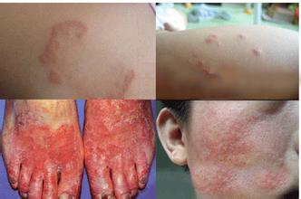 治脚癣手癣最有效的偏方,除去脚癣的中药有什么