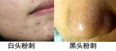 脸上不断的长痘痘和闭合性粉刺,青少年脸上的闭合性粉刺能不能挤
