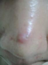 别盲目去黑头，先搞懂“黑头”是啥？