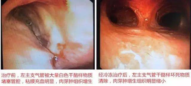 支气管结核冷冻,气管结核晚期死亡
