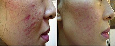 痘印难消吃什么维生素,痘印难消