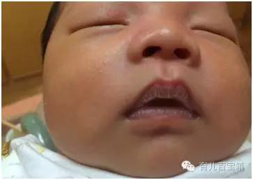 小儿腹泻要有哪些不适,轮状病毒感染性腹泻高发期