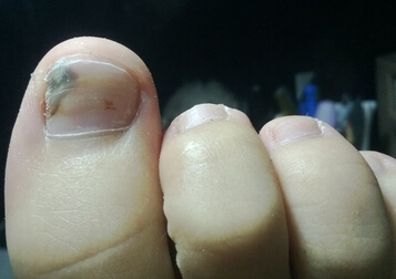 灰指甲的病因、症状及危害，颜色不是唯一的诊断标准！