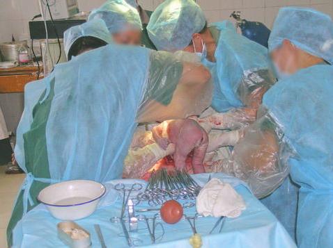 剖腹产的妈妈有多伟大,剖腹产的妈妈最伟大