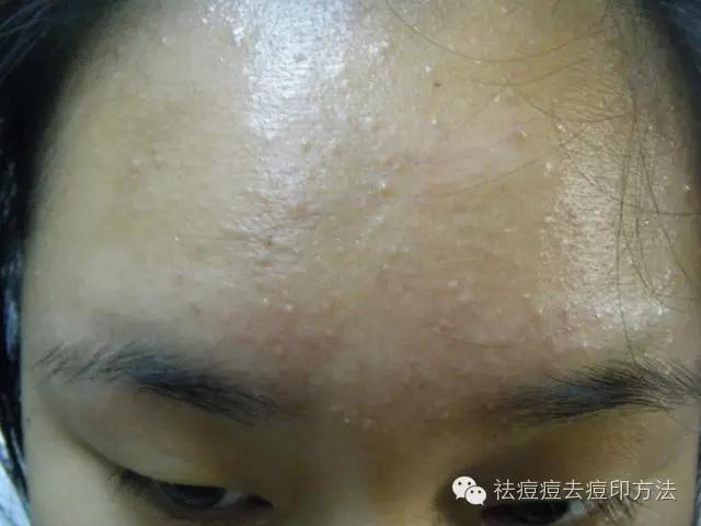 祛痘闭合性粉刺的产品,闭合性粉刺祛痘