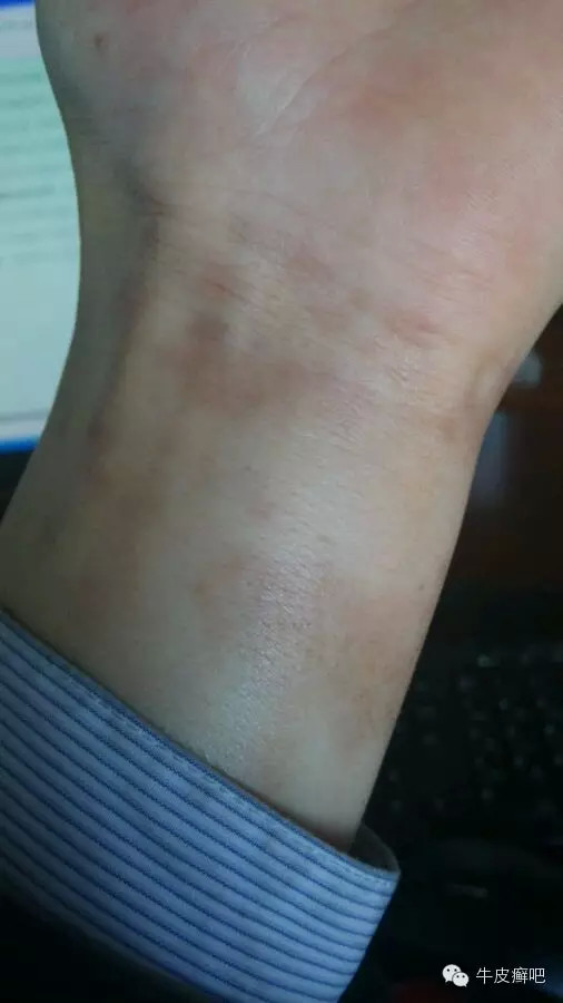 医院专家教你治疗牛皮癣,专家专治牛皮癣方法