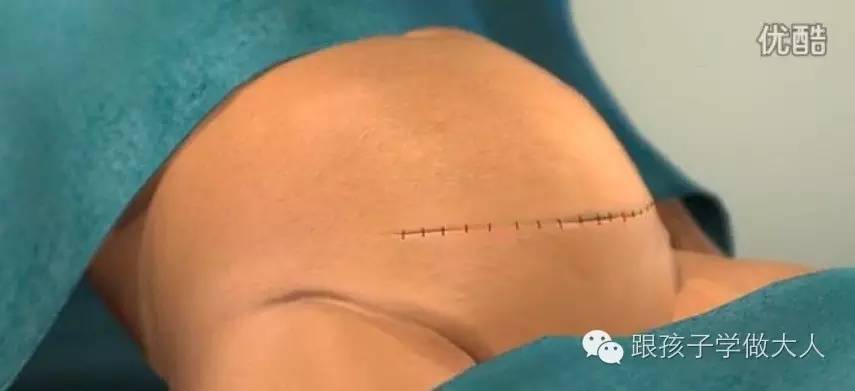 一些关于剖腹产的细节你知道多少,剖腹产最难的一个步骤