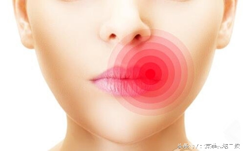 夏天嘴角老烂是什么原因,夏天嘴角烂了怎样好得快