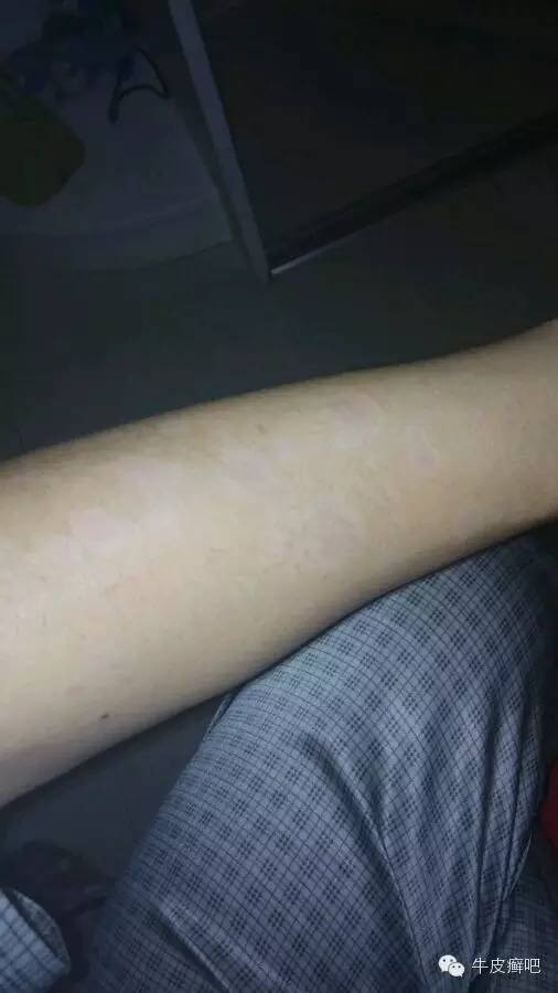 医院专家教你治疗牛皮癣,专家专治牛皮癣方法