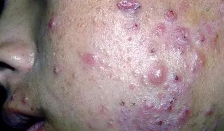 痘痘的分类及形成原因,痘痘的分类和形成原因图片