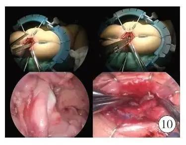 手术演示肠造口术后单切口腹腔镜辅助巨结肠根治术（Duhame1术）