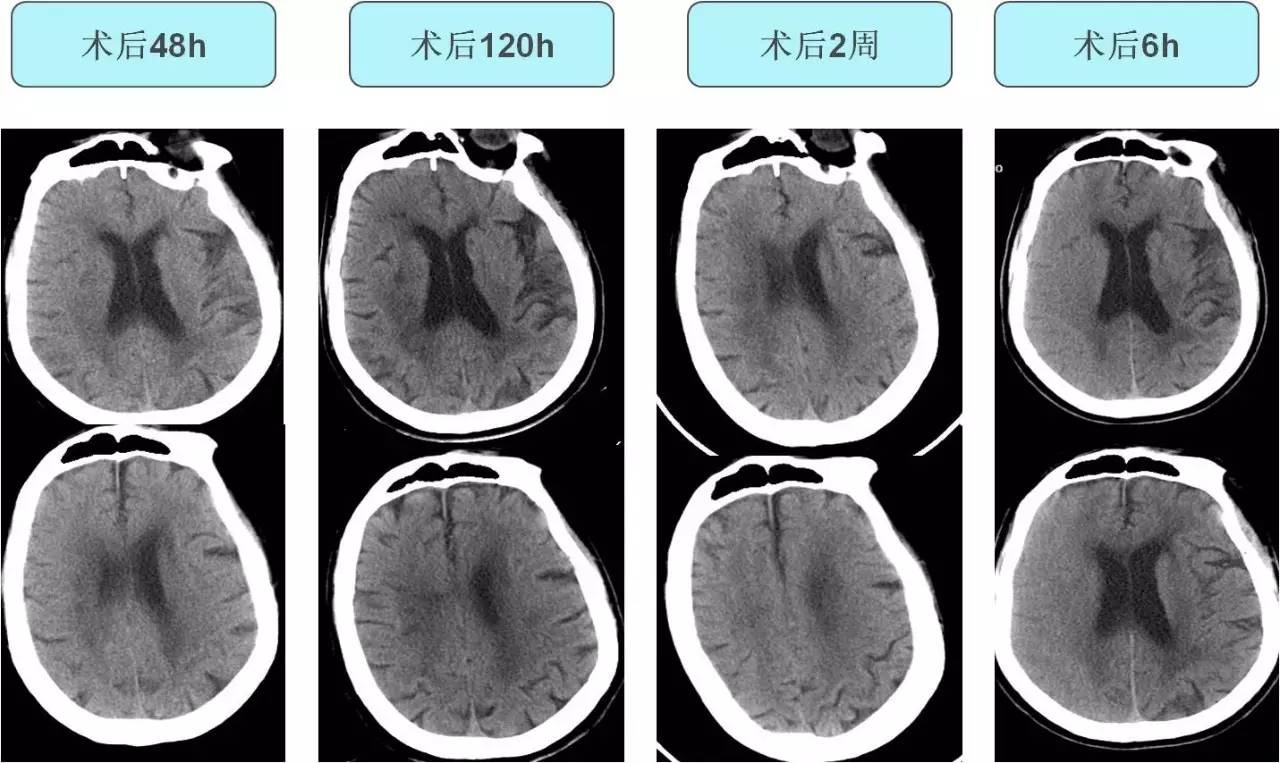 脑高灌注的处理措施,脑高灌注是什么意思