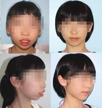 矫牙经历的几个阶段,科普牙齿矫正一定要拔牙吗