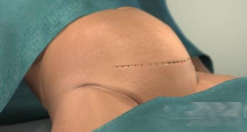 剖腹产的女人请好好珍惜,剖腹产女人要受多少罪