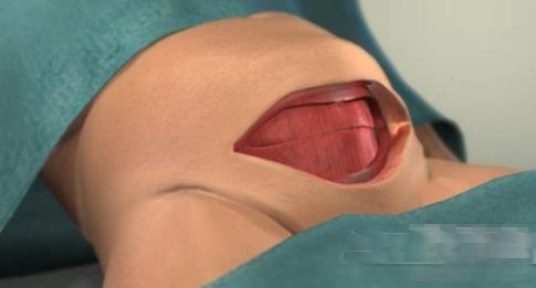 剖腹产女人不可逆的伤害,剖腹产请善待妈妈