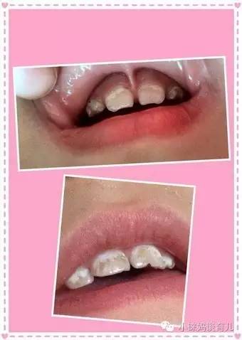 儿童乳牙龋齿烂了有必要补牙吗,乳牙蛀了是套牙套还是补牙