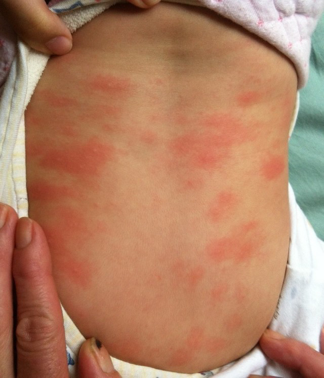 孩子身上起红疙瘩很痒什么情况,身上起红疙瘩还痒图片