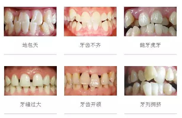 常见排齐牙齿的四大方法,牙齿拥挤重叠矫正过程